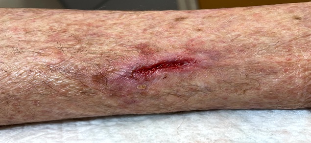 Wound Care Image